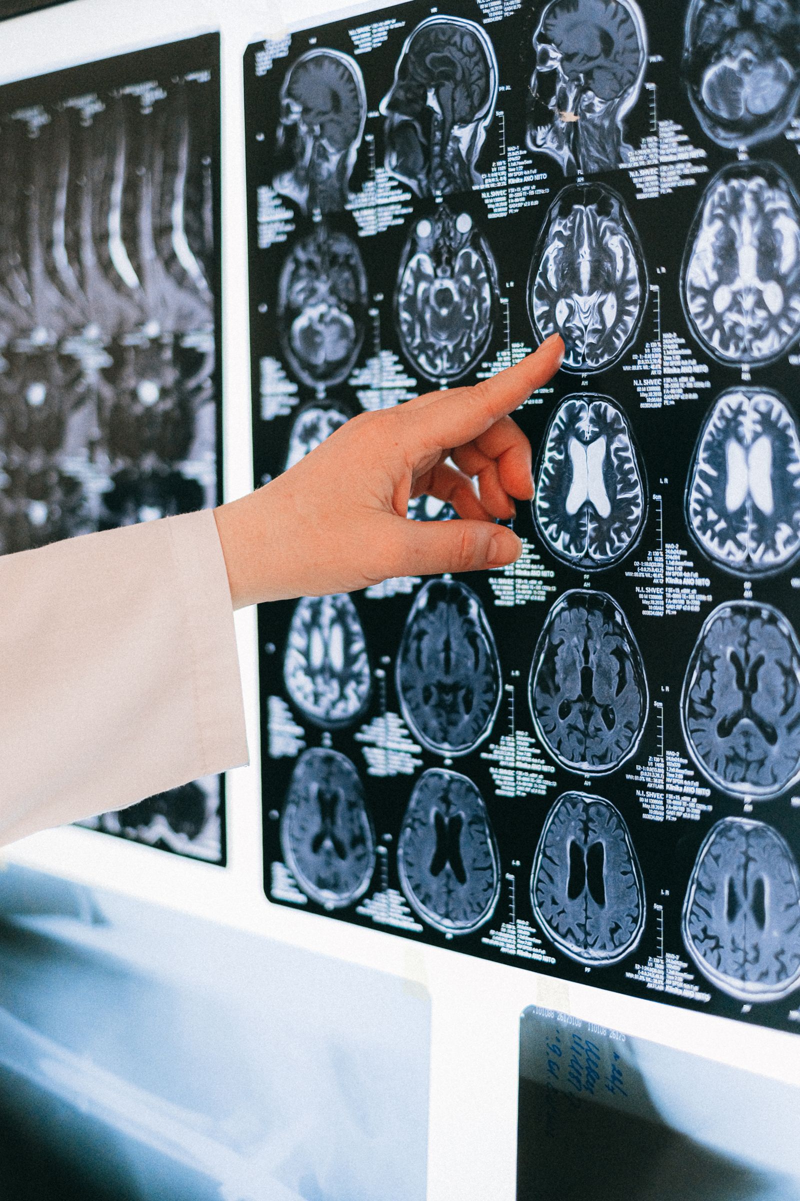 A doctor's hand pointing to a brain MRI scan on a lightbox